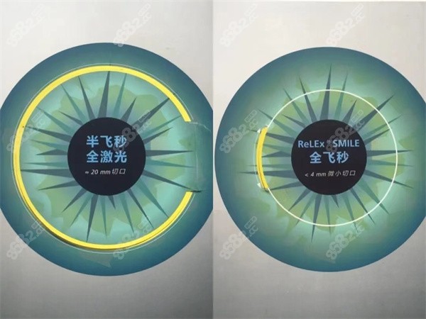 激光类近视手术 激光类近视手术