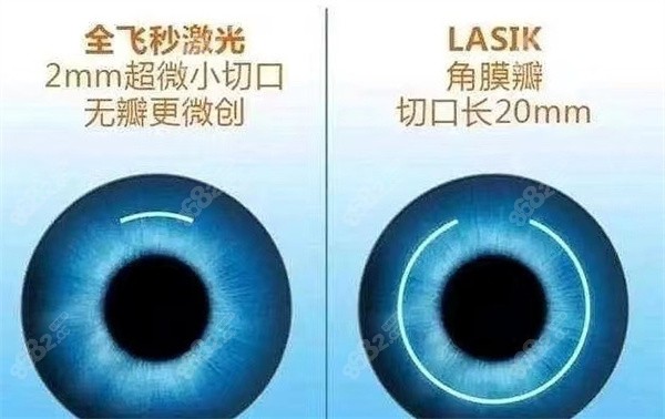 近视手术 近视手术