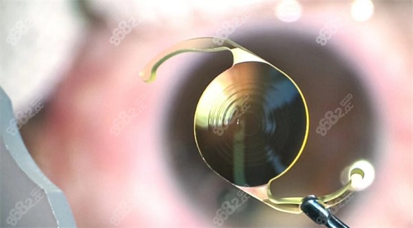 晶体植入近视手术价格收费 晶体植入近视手术价格收费