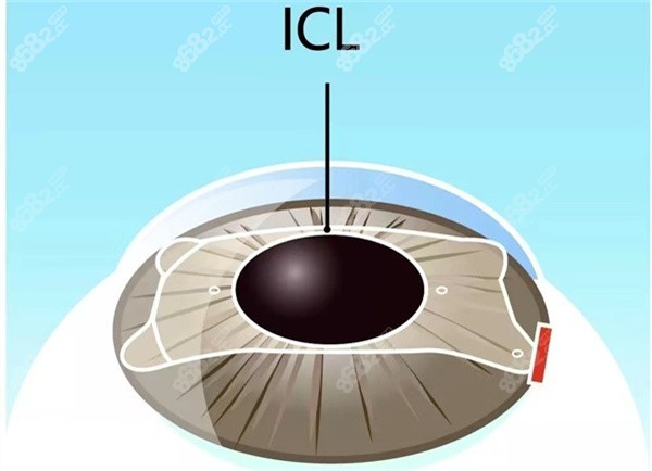 近视手术 近视手术