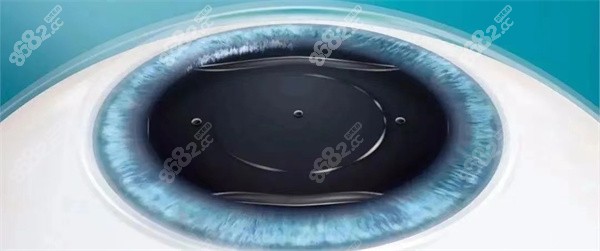 做晶体植入近视手术适合哪些类型人群 做晶体植入近视手术适合哪些类型人群