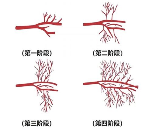 雷诺瓦治疗ed管用