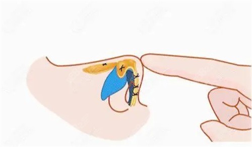 成都艾米麗整形醫(yī)院做鼻子價格多少錢？