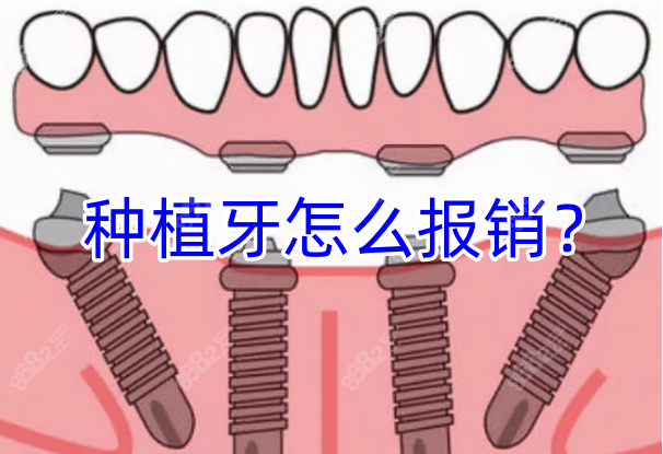 种植牙怎么报销？www.8682.cc