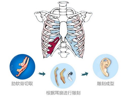 张正文耳再造口碑怎么样