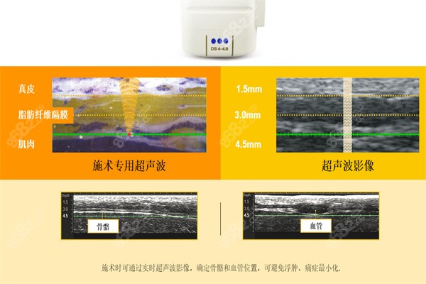 美版超声炮施术原理一览