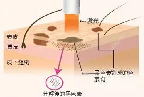 重庆艺星医疗美容医院祛斑技术不错