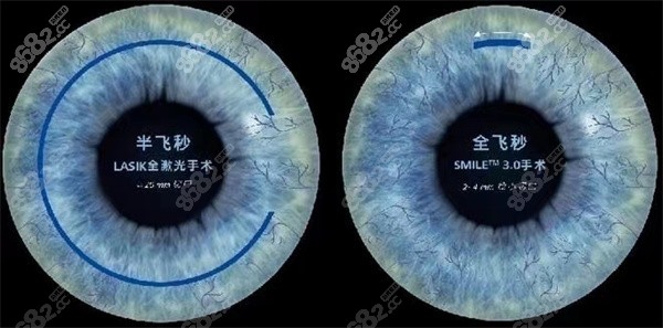 做完近视手术成效可以维持多久