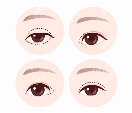 史迎軍修復雙眼皮價格是多少？