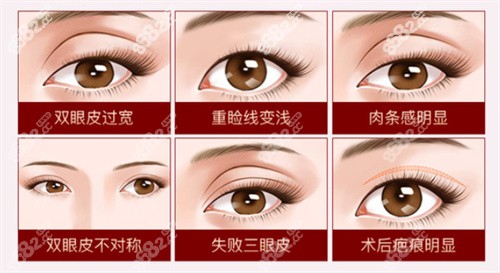 史迎軍修復雙眼皮怎么樣？