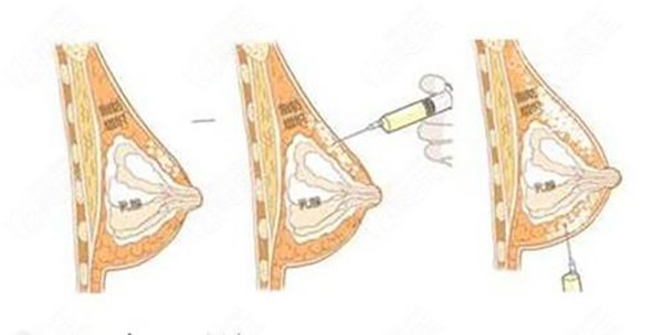 注射隆胸和假体隆胸哪个更好