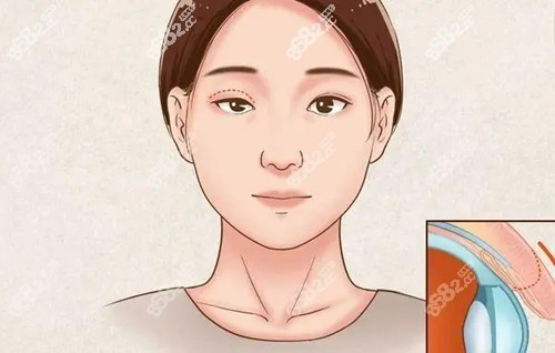 史迎軍雙眼皮修復靠譜嗎？