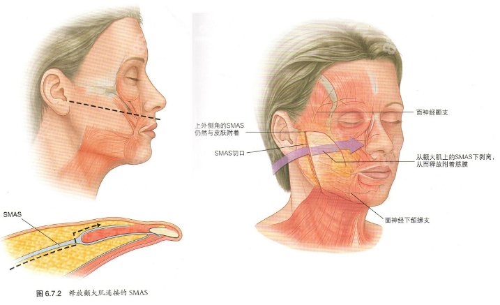 李<!--<i data=20240705-sp></i>-->高位SMAS除皱术8682.cc