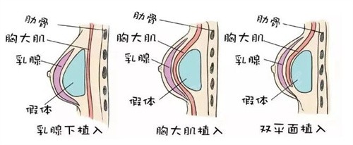 李<!--<i data=20240705-sp></i>-->隆胸预约挂号