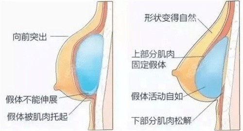 李<!--<i data=20240705-sp></i>-->隆胸手术技术怎么样