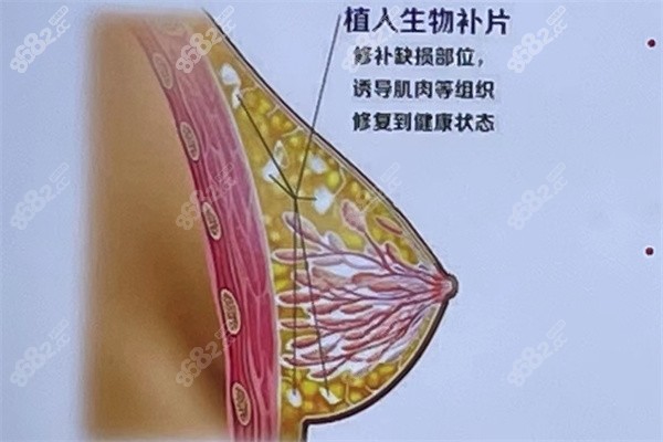 西安国医医学中心生物补片胸