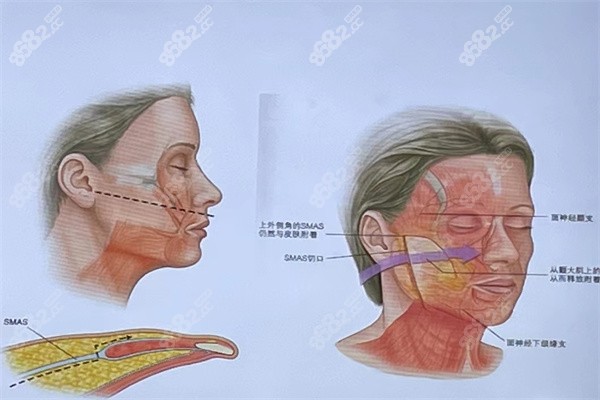 李<!--<i data=20240705-sp></i>-->医生高位SMAS筋膜层大拉皮