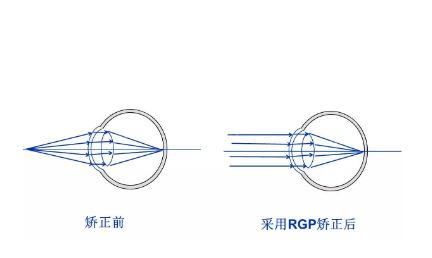 RGP的矫正<span style=