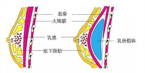 李<!--<i data=20240705-sp></i>-->隆胸口碑评价好不好