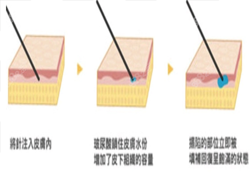 重庆玻尿酸填充图