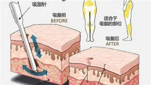 在沈阳杏林医院做过大腿吸脂的都说很靠谱