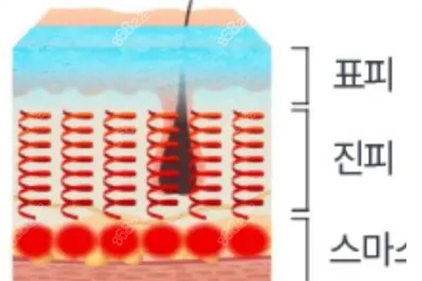 韩国钛提升原理