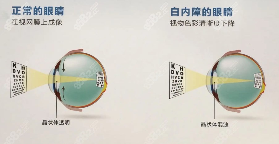 强生新无极人工晶体缺点