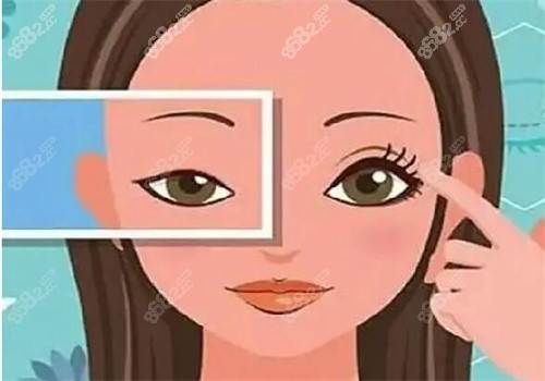 吳焱秋高難度雙眼皮修復(fù)實例多