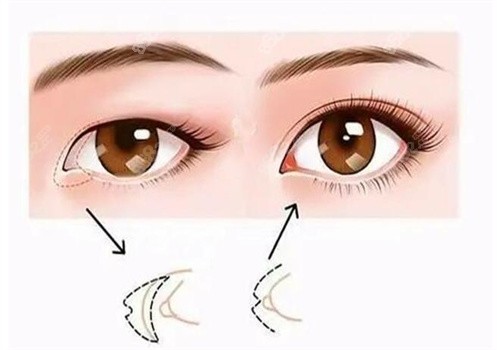 吳焱秋高難度雙眼皮修復(fù)技術(shù)靠譜