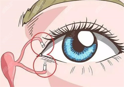 吳焱秋高難度雙眼皮修復(fù)口碑好