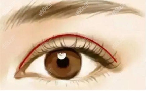 高亞?wèn)|做雙眼皮修復(fù)怎么樣