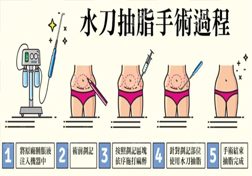  国内吸脂手术图