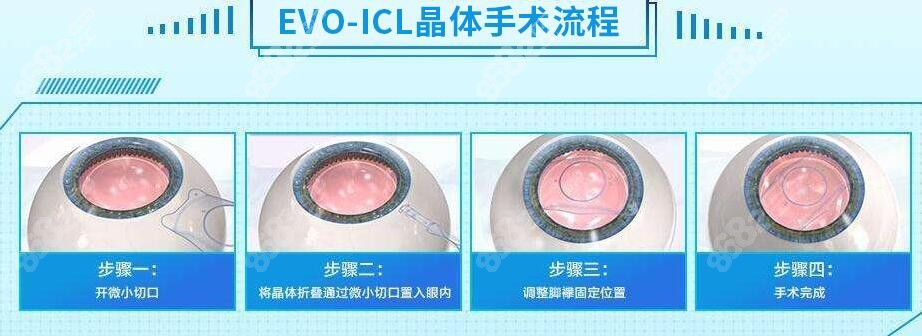 北京近视眼矫正晶体植入价格多少钱