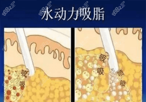  国内吸脂手术图