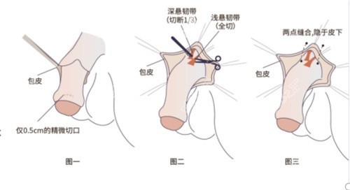 阴茎假体植入手术要多少钱?
