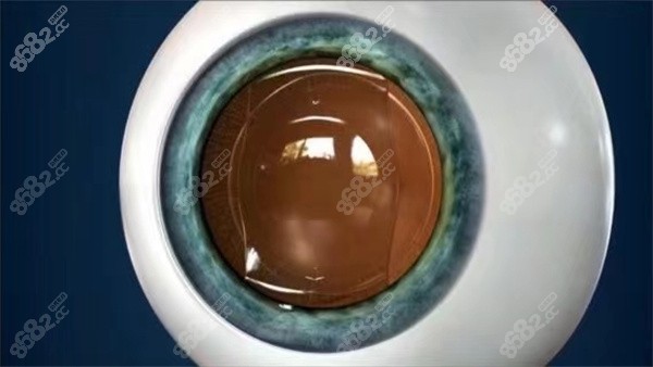 做近視手術(shù)需要準(zhǔn)備花費(fèi)多少錢(qián)