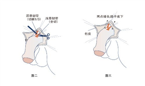 影响阴茎假体植入手术价格的因素有哪些？