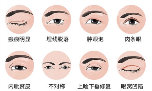 长沙爱思特张姣姣修复双眼皮口碑好
