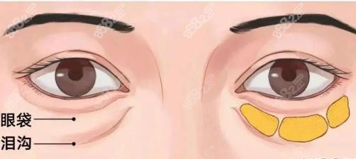 哈爾濱宋桂霞眼袋修復(fù)