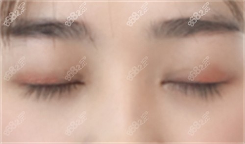张姣姣修复双眼皮怎么样？