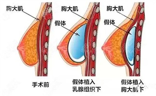 包膜挛缩怎么处理