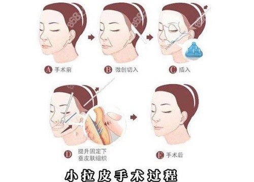 哈尔滨瑞丽杨永胜大拉皮