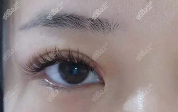 做完近视手术后的其他注意事项