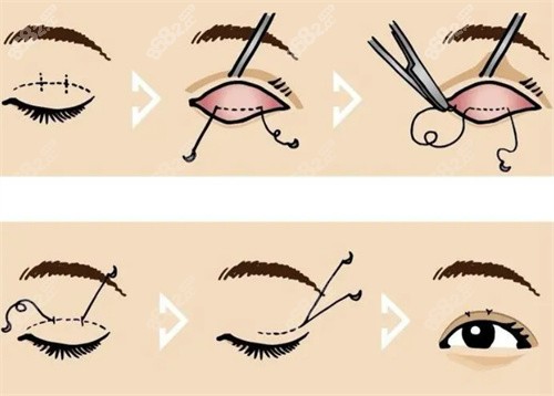 大連愛德麗格劉志剛做雙眼皮修復(fù)怎么樣