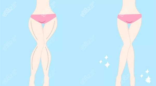 吸脂
