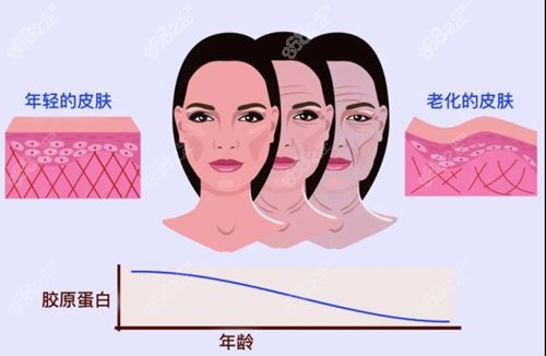 弗缦胶原蛋白注射层次是越深越持久吗