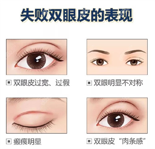 大连爱德丽格双眼皮失败类型