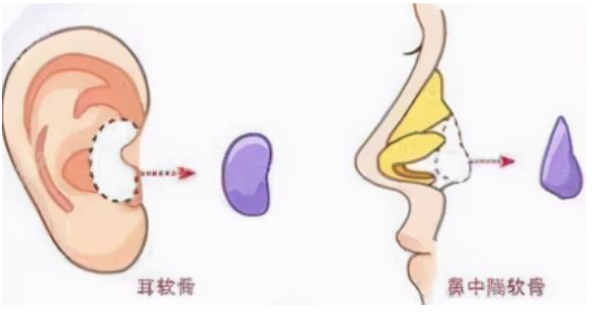 巫文云医生隆鼻