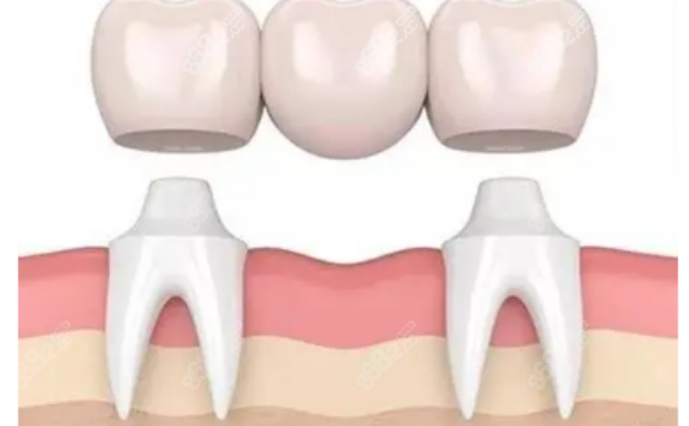 乌鲁木齐天牙口腔门诊种植牙