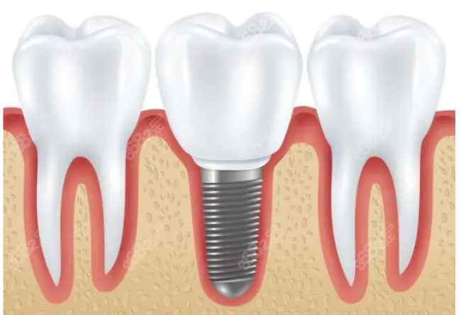 乌鲁木齐天牙口腔门诊种植牙